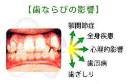 歯並びの影響