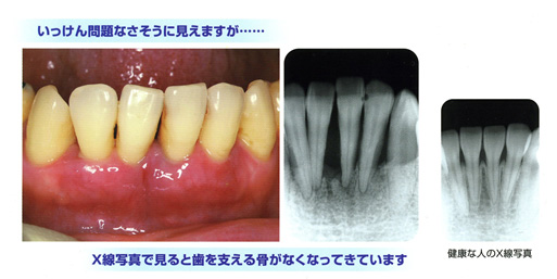 X線で見た歯周病写真