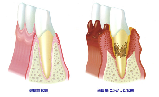 健康な歯と歯周病にかかった状態の歯と歯ぐきの断面図